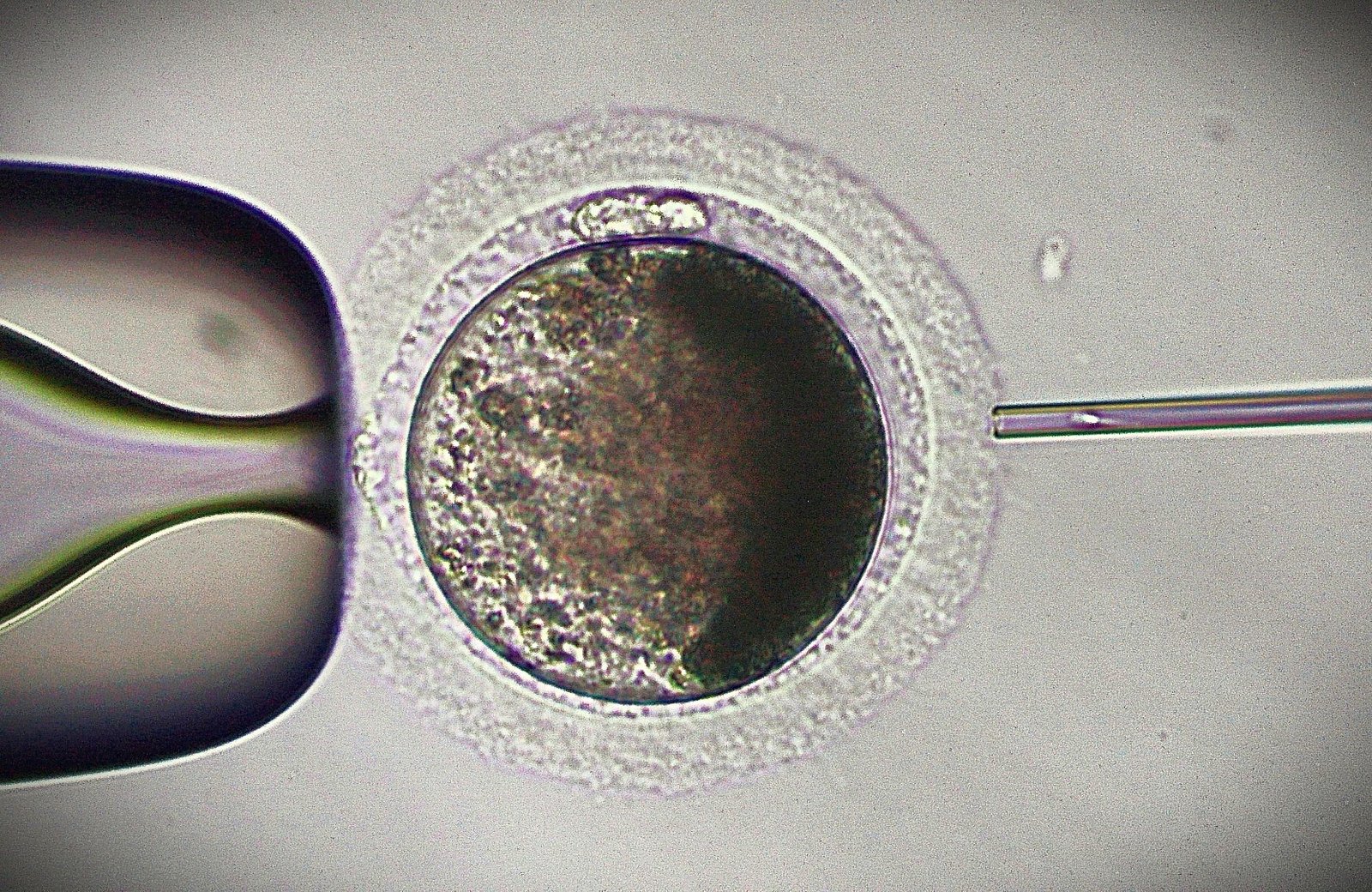 Intracytoplasmic Sperm Injection (ICSI)